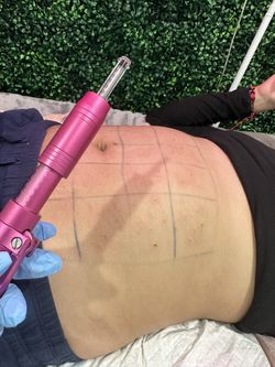 Fat Dissolver No Needle No Pain
