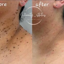 Verrugas? Skin Tags? Ask For Details