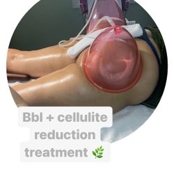 Vacuum Therapy Body Sculpting Radio Frequency