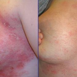 Psoriasis Body Wash Samples 