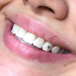 Tooth Gem