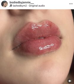 Lip Filler