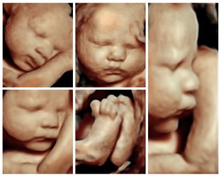 BABY ULTRASOUNDS! Gender Determination