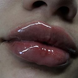 Lip Filler Lip Models