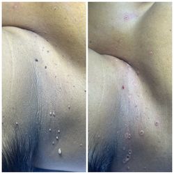 Skin tact removal