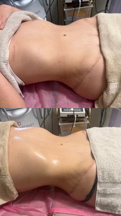 Drenaje Linfatico Post Operatorios