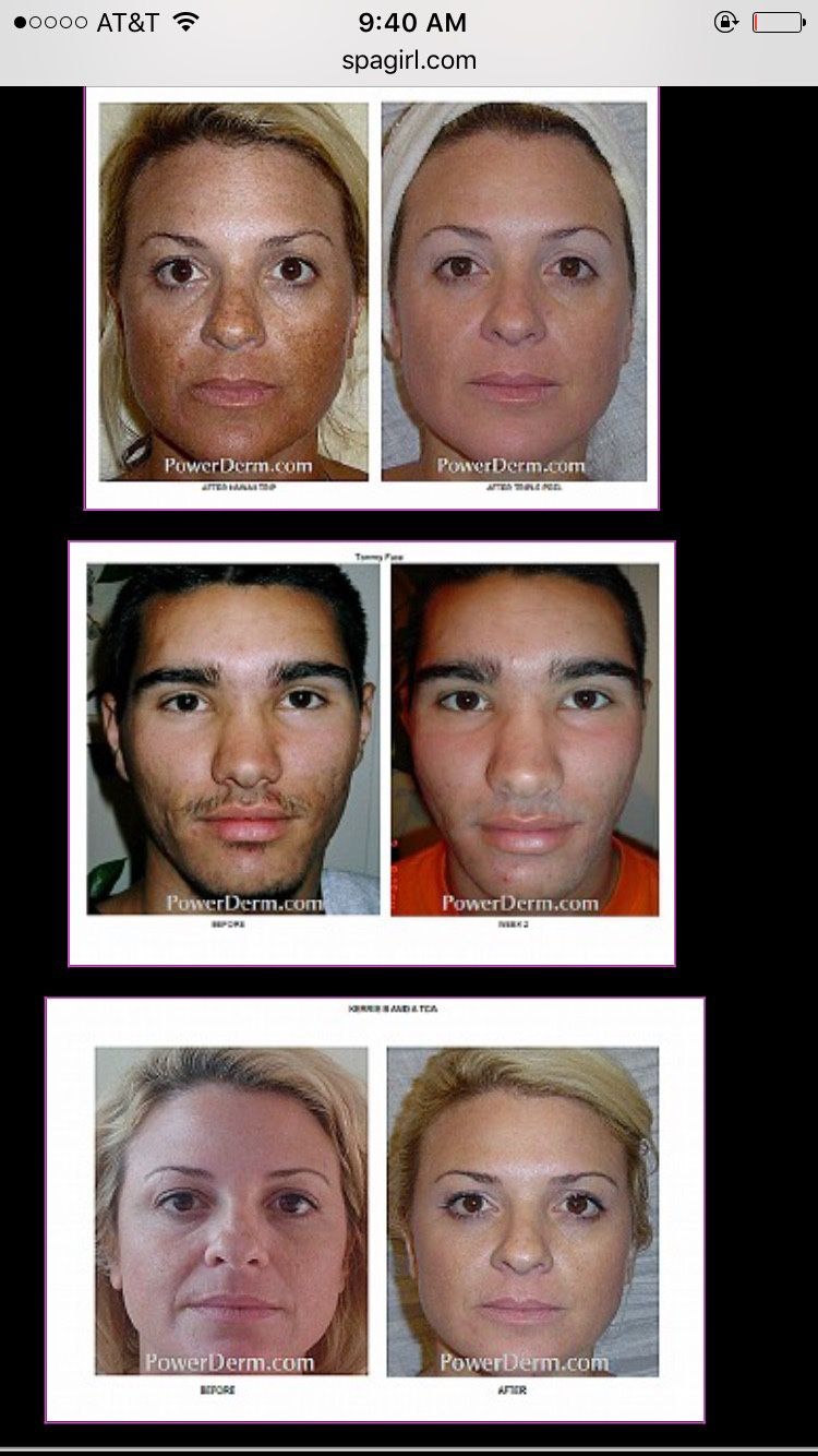 Kinetic Dermabrasion Facial equipment