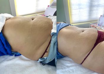 Body Sculpting Radio Frequency CavitationAnd More