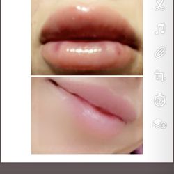 Hyaluron Pen Lip Fills