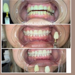 Teeth Whitening 