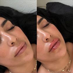 Lip filler