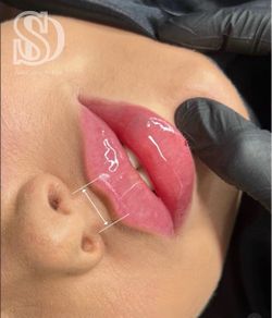 Inyección de labios