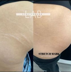 Stretch Marks
