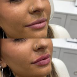 Lip Filler/beauty Product