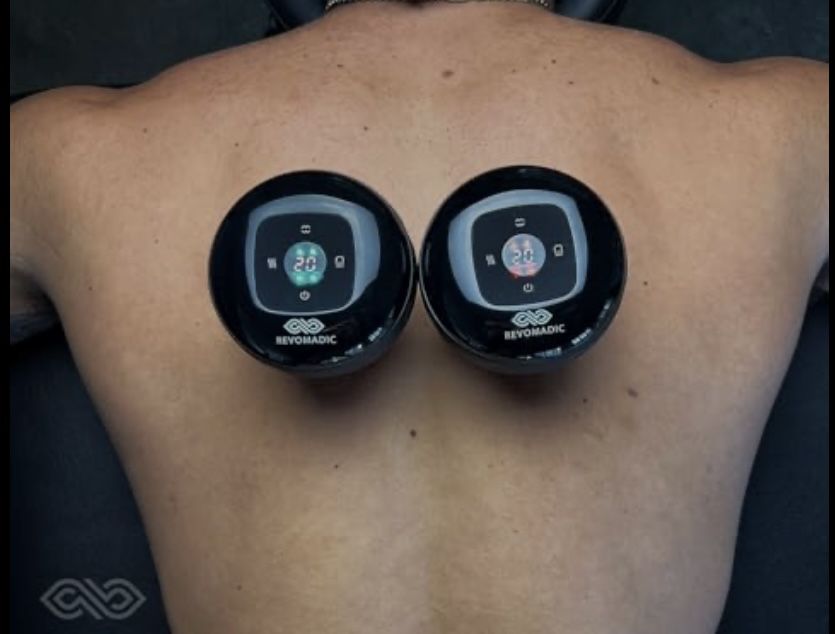 Cupping therapy