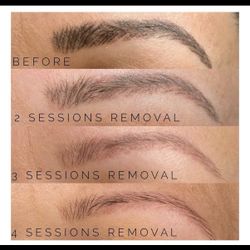 Microbladding Brow Removal