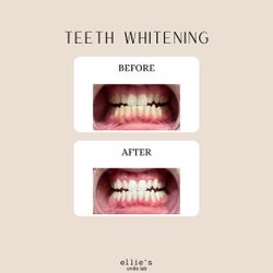 Teeth Whitening Treatment