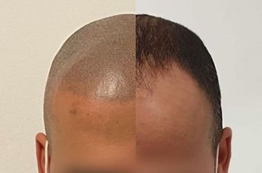 Hairloss Solution