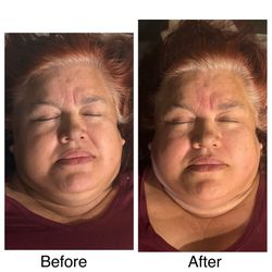 Natural-lift Facial