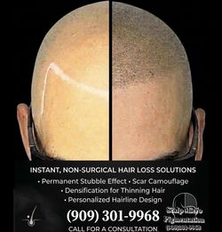 Hair loss smp