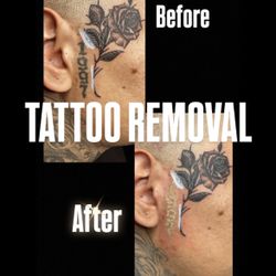 Removal