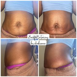 Body Contouring