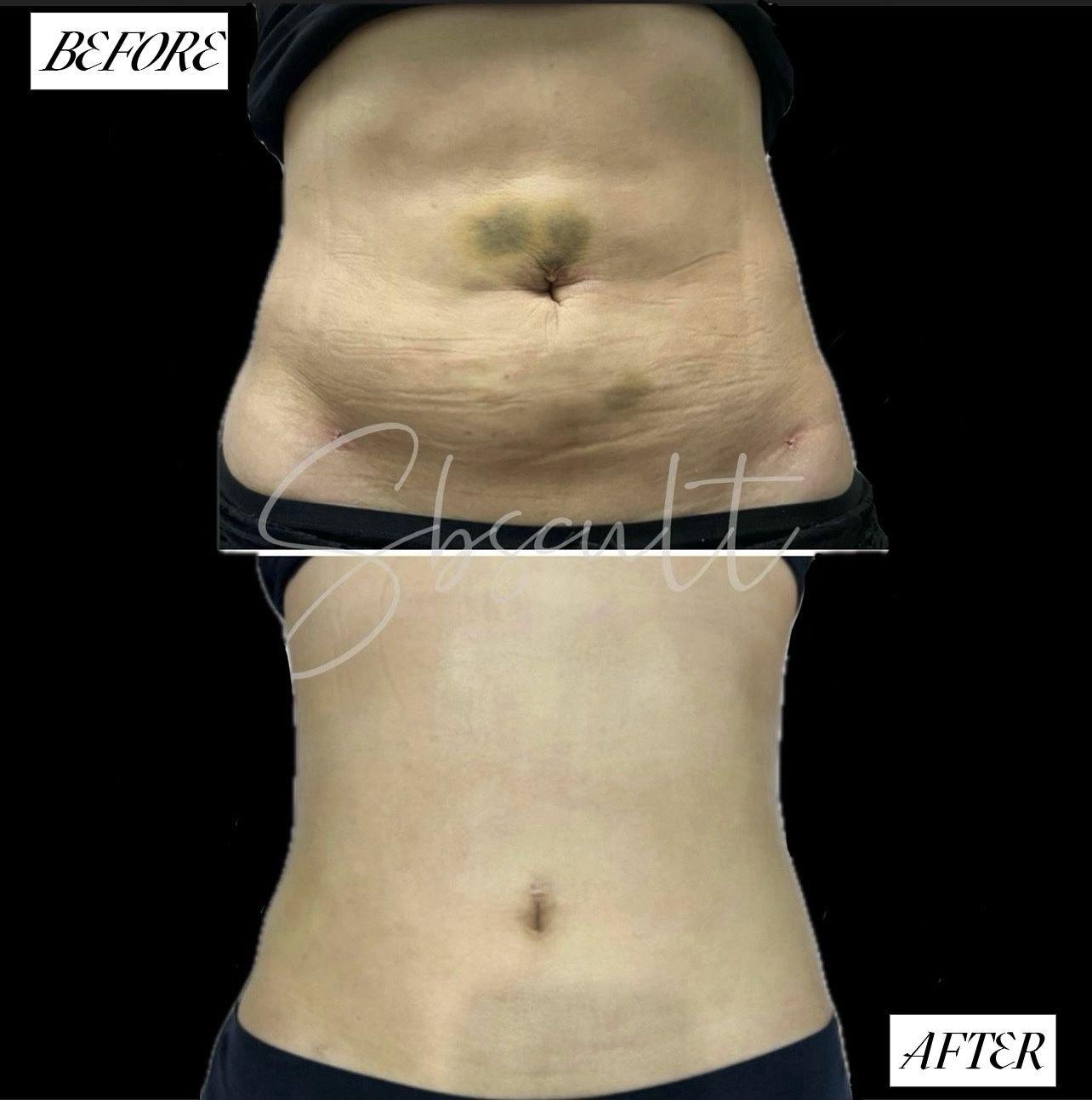 Lymphatic Post-op Supplies