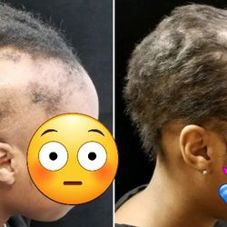 Bald Spots, Hair Thinning, Alopecia, Scalp Irritation 