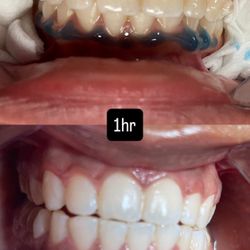 Teeth Whitening