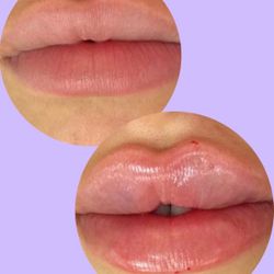 Fillers