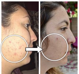 Acne natural Face cleanser