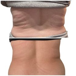 Fat Reduction Machine