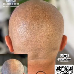 Free Consultation For Hair Loss