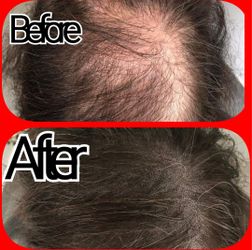 Reverse Hairloss