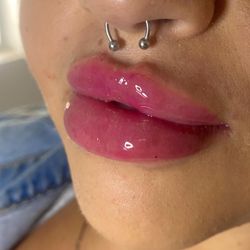 Lip Filler In OC