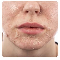 T-A Skin Peeling Solution Kit 30% 1 fl oz