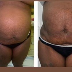 Look And Feel Amazing! Body Sculpting Contouring Weight Management Loose Inches In Minutes 