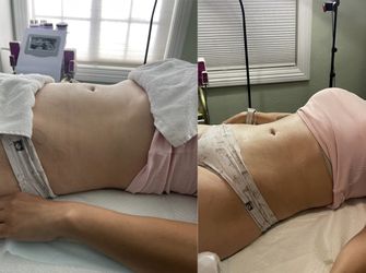 Body Sculpting Cavitation And More