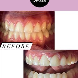 Teeth Whitening