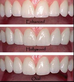 Teeth whitening & v3neerss