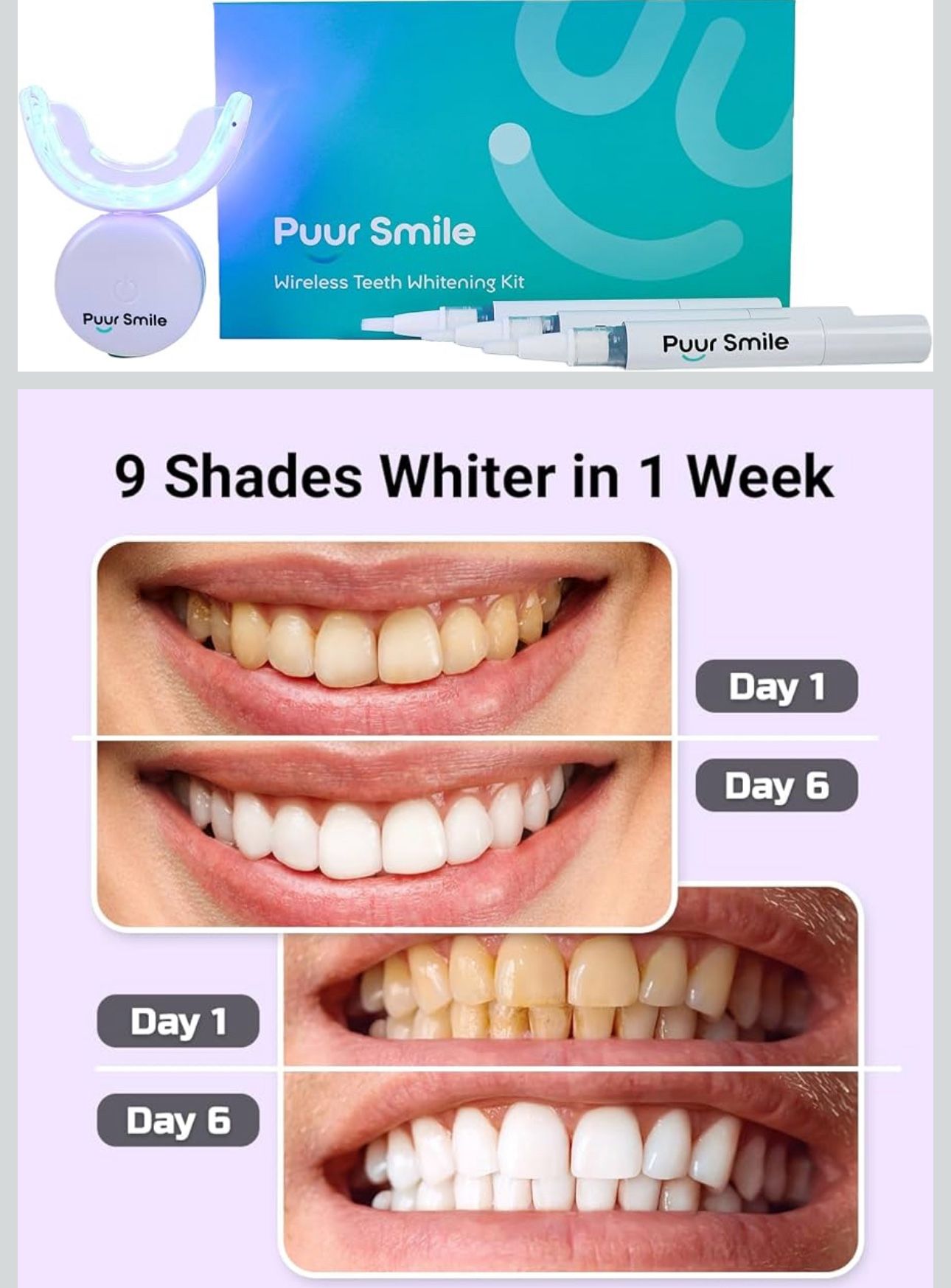 Kit de blanqueamiento dental