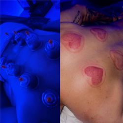 Cupping Therapy 