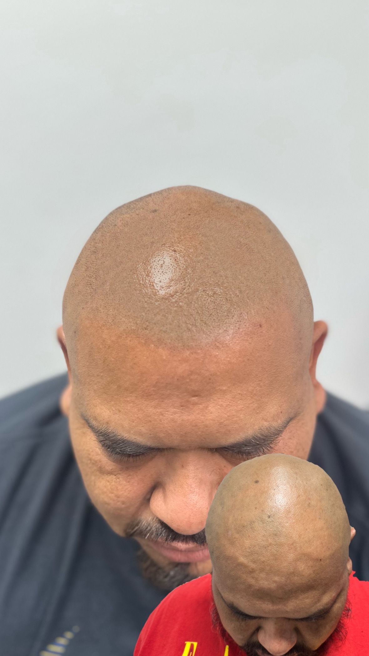 Hairloss Solution 