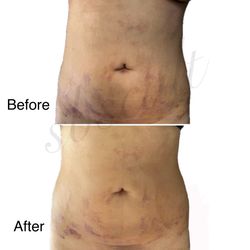 Lymphatic Care Post Op Materials