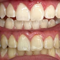 Teeth Whitening