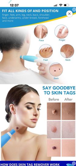 AUTO SKIN TAG REMOVER KIT