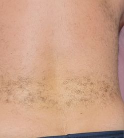 Back Waxing for MEN
