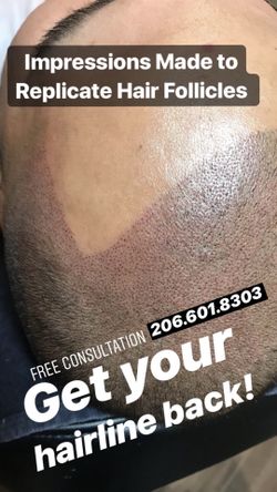 Scalp Micropigmentation