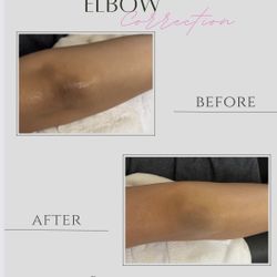Skin Lightening Treatment For Hyperpigmentation 