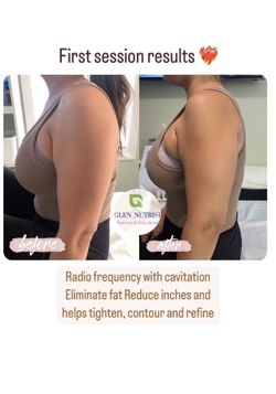 Body Sculpting Skin Tightening